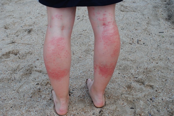 rash on My legs